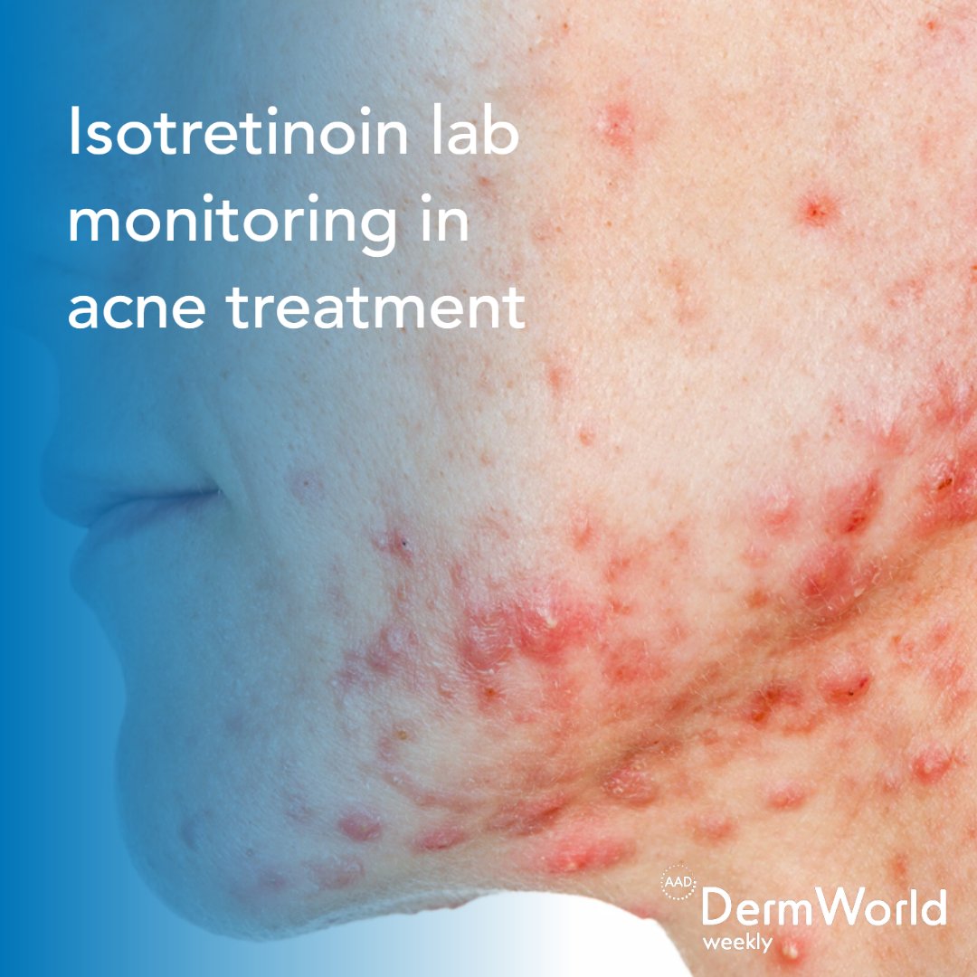 .<a href="/JAMADerm/">JAMA Dermatology</a> authors developed a consensus statement about the optimal approach to lab monitoring for healthy patients treated with #isotretinoin for acne. Find out what testing is recommended and when in #DermWorldWeekly. bit.ly/3RifeOR