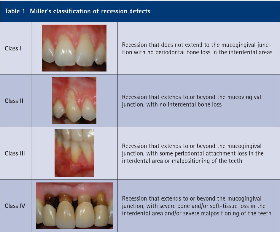 Dr_Nawaf_83's tweet photo. One of the most #treatments that #Periodontist did is the problem of soft tissue ( #Gingiva ).
This is one of the most familiar classification of recession that  #Dentist should be aware of it
( Miller's classification )
 👇🏽
@saudiperio
#perio_tweets
#gingiva
#recession https://t.co/dNFPgiHaF0