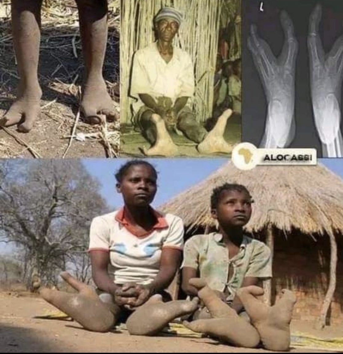 cakesoap_'s tweet photo. #DidYouKnow ? There is a tribe in #Zimbabwe 🇿🇼 called Vadoma. They all carry a genetic defect in which they only have two toes 👀 and they see it as a blessing 🙏🏼 https://t.co/m2ysrDshog
