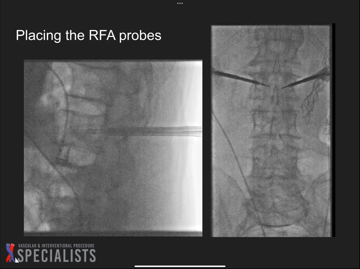 darthglader's tweet photo. #OsteoCool RFA followed by #kyphoplasty. 

#NegativeStylePoints for the cement in the disc space, but overall good fill. 
#FillGoals 
#WallToWallFloorToCeiling https://t.co/K7VxpbRFeL