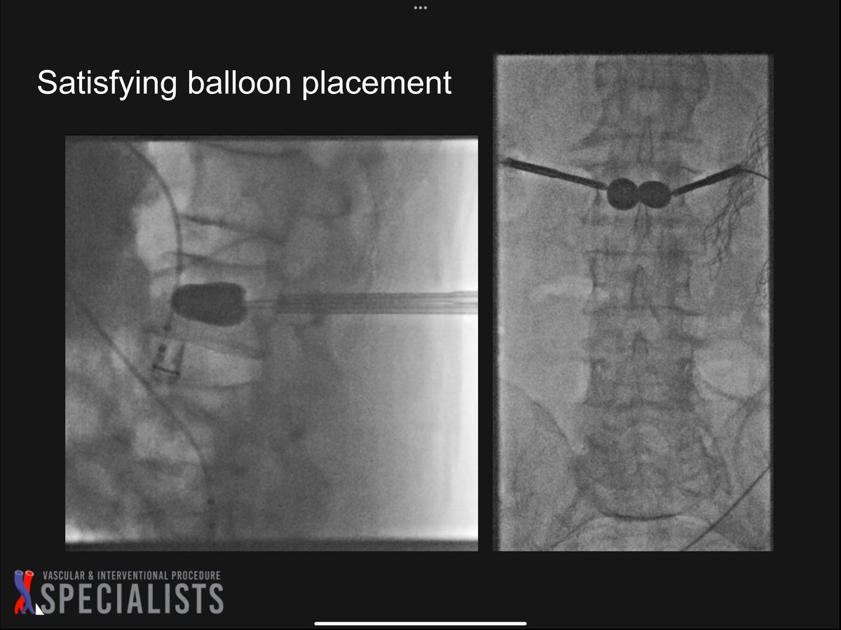 darthglader's tweet photo. #OsteoCool RFA followed by #kyphoplasty. 

#NegativeStylePoints for the cement in the disc space, but overall good fill. 
#FillGoals 
#WallToWallFloorToCeiling https://t.co/K7VxpbRFeL