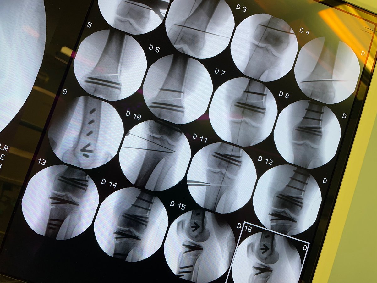PhilippNiemeyer's tweet photo. What is your opinion about double level osteotomies in order to realign as anatomic as possible: Double Trouble or Double Helpful ? #osteotomy #knee #realign #hto #dfo #malalignment #correction #ortho #orthotwitter #surgery https://t.co/VH5NTucepB