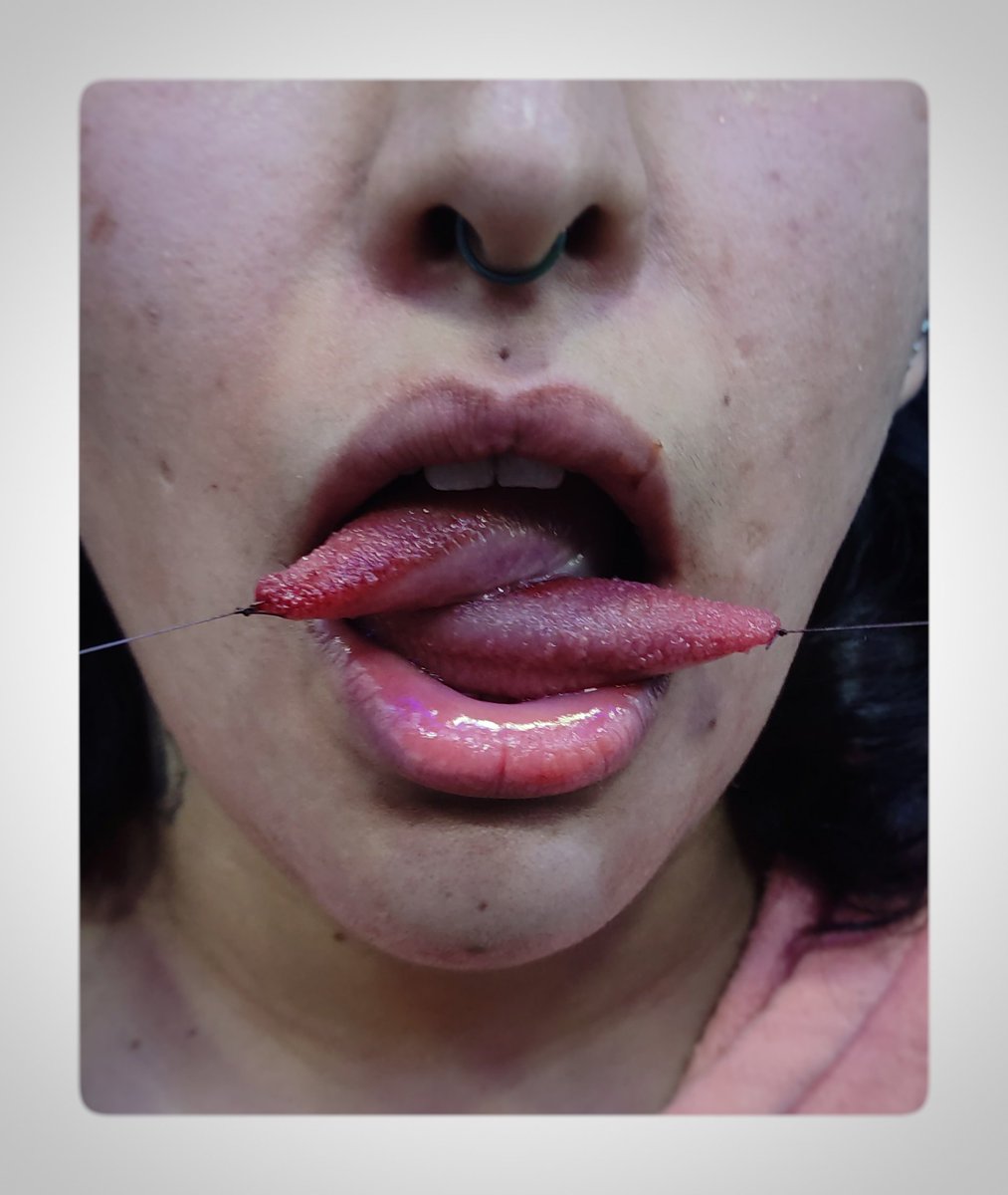 shoyu_irezumi's tweet image. 🐍𝕋𝕠𝕟𝕘𝕦𝕖 𝕤𝕡𝕝𝕚𝕥 𝕗𝕣𝕖𝕤𝕙👅
.
#tonguesplit fresh ⚡
-
Cotizá tu próximo proyecto mediante DM 
-
-
Visita mi perfil en @shoyu_irezumi.
-
-
#modificacioncorporal #piercer #astmf136 #tonguespliting #lenguabifida #piercings #titaniogradoimplante #shoyuirezumi #modified