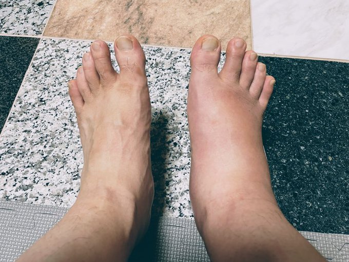 右足かなり良くなったと思うけど並べてしまうと一目瞭然である 