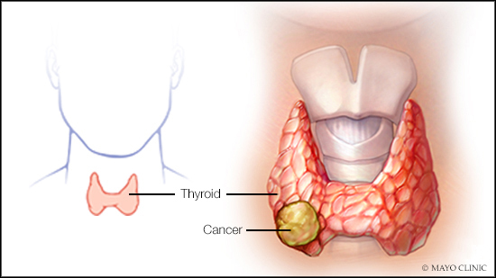 #ThyroidCancer occurs more often in women than men, however, there are other factors that may increase the risk of this disease. Learn about the risks, diagnosis and treatment. mayoclinic.org/diseases-condi… #CancerCare