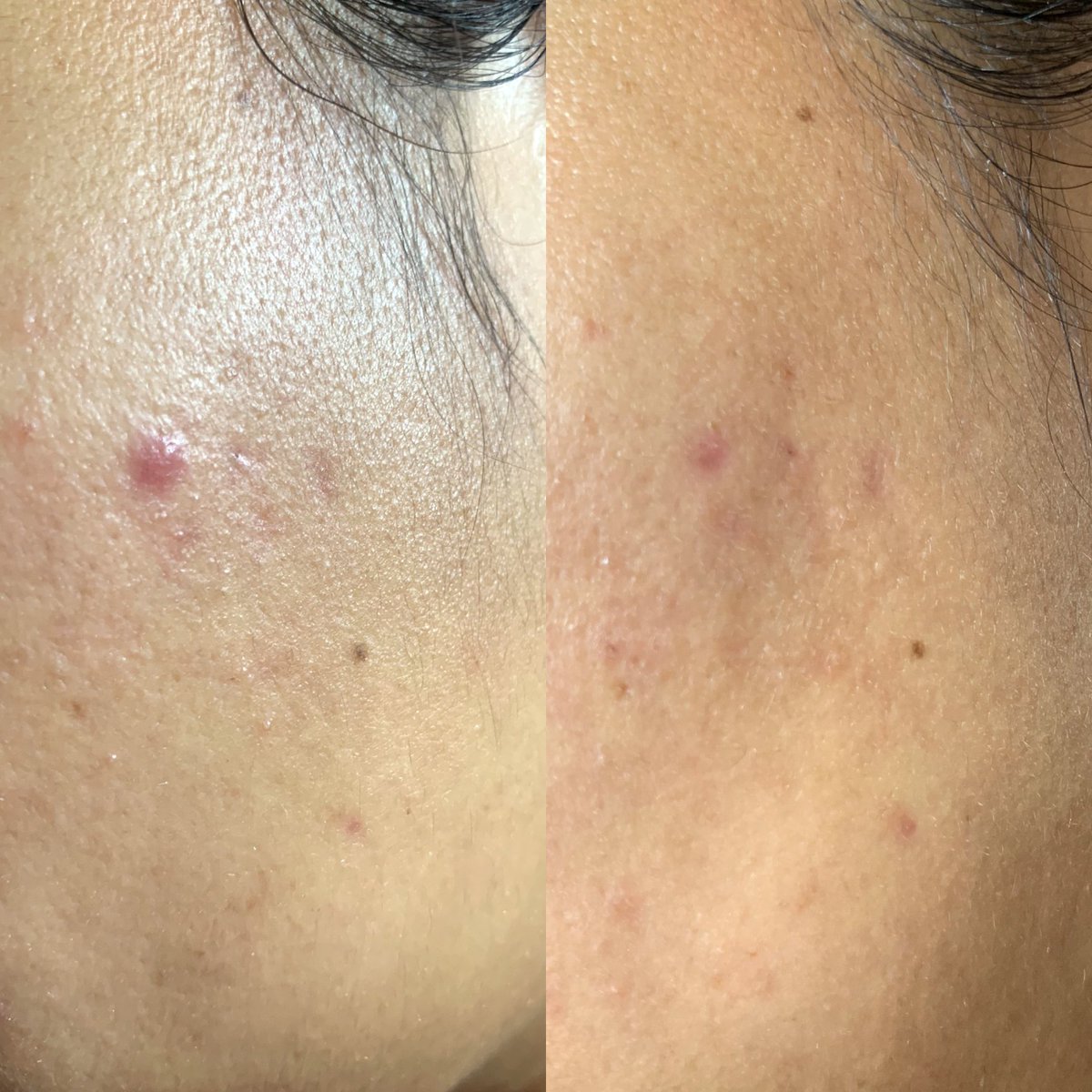 Dchangeskincare's tweet photo. Dari dulu banyak banget yang rekomendasiin acne gel ini, akhirnya aku coba juga dong.
Sebelum pada bingung kenapa ada kata "Regular" nya, jadi Adara punya 2 obat totol jerawat. Nah yang aku pakai sekarang versi regular nya ya 😊.
#racuninskincare #LetsBeeClear https://t.co/TSfcGKJxTV