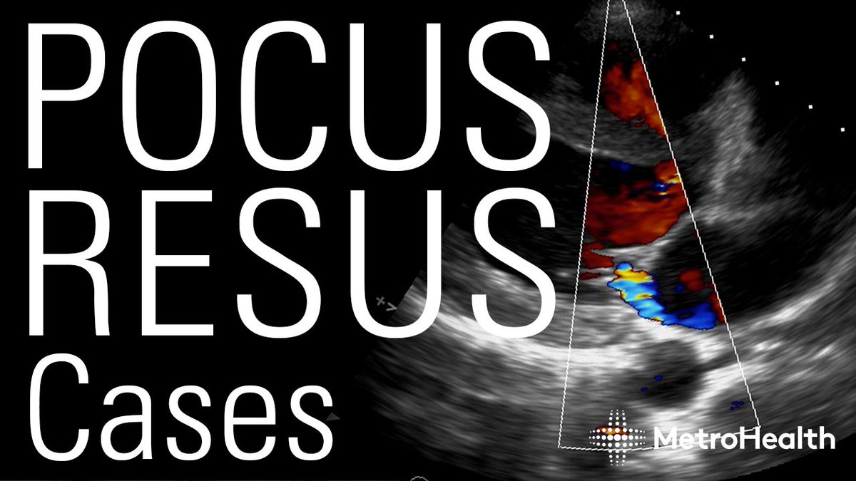 MH_EMultrasound's tweet image. Resus Cases by @SLWerner_EM from our Ultrasound Grand Rounds.  

youtu.be/g9TQs05LL5g

#MetroEUS

#POCUS #Ultrasound #FOAMed #FOAMus #MedTwitter #EmergencyMedicine #CriticalCare #echofirst