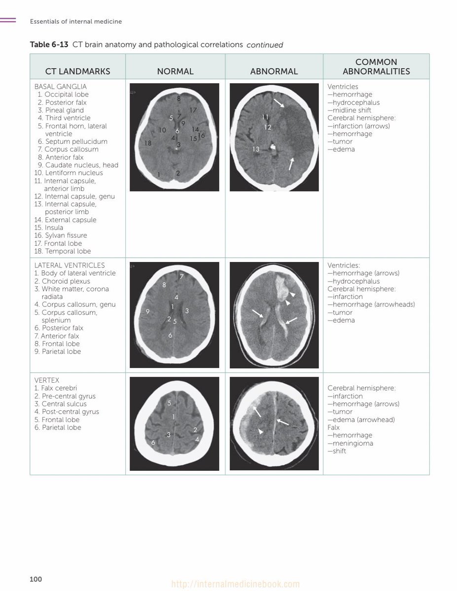 Medical_MD1's tweet image. Brain CT scan ✨
Great differentiation between 
Normal vs Abnormal signs 👌🏼🤩
.