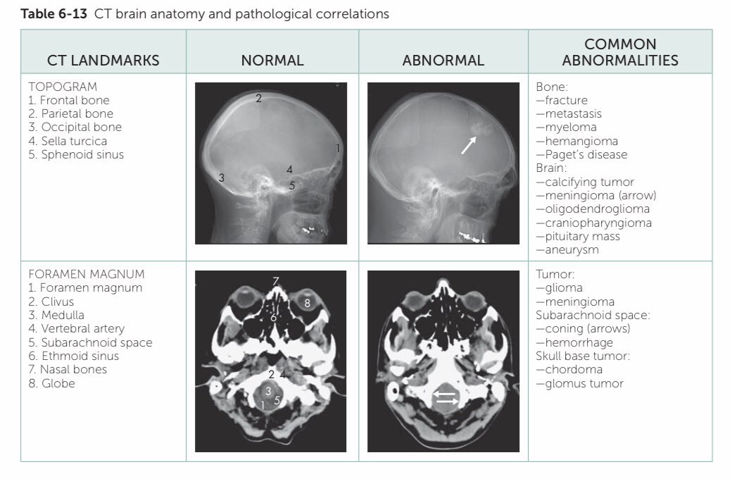 Medical_MD1's tweet image. Brain CT scan ✨
Great differentiation between 
Normal vs Abnormal signs 👌🏼🤩
.