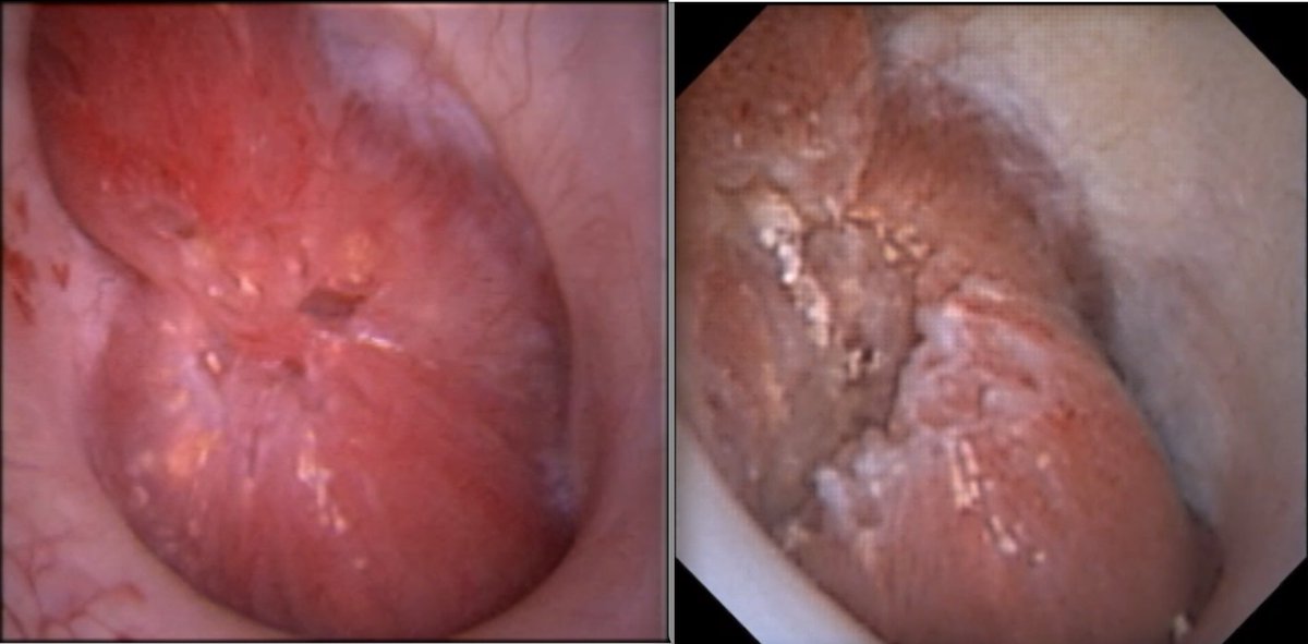 Ever wonder what becomes of the renal papilla after laser papillotomy to remove plugging stones? Picture on the right is 7 years later <a href="/IUendourology/">IU Endourology</a>