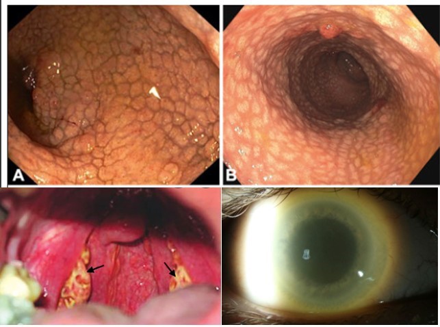 IsabelSolares7's tweet photo. 🚑Paciente con:

-Amígdalas y mucosa colónica ANARANJADAS 🍊

-Opacidad corneal 👁️

-Niveles séricos bajos de HDL  🩸

-Polineuropatía 🤌

¿Qué enfermedad rara deberíamos sospechar 🩺? https://t.co/xvmCoje25o