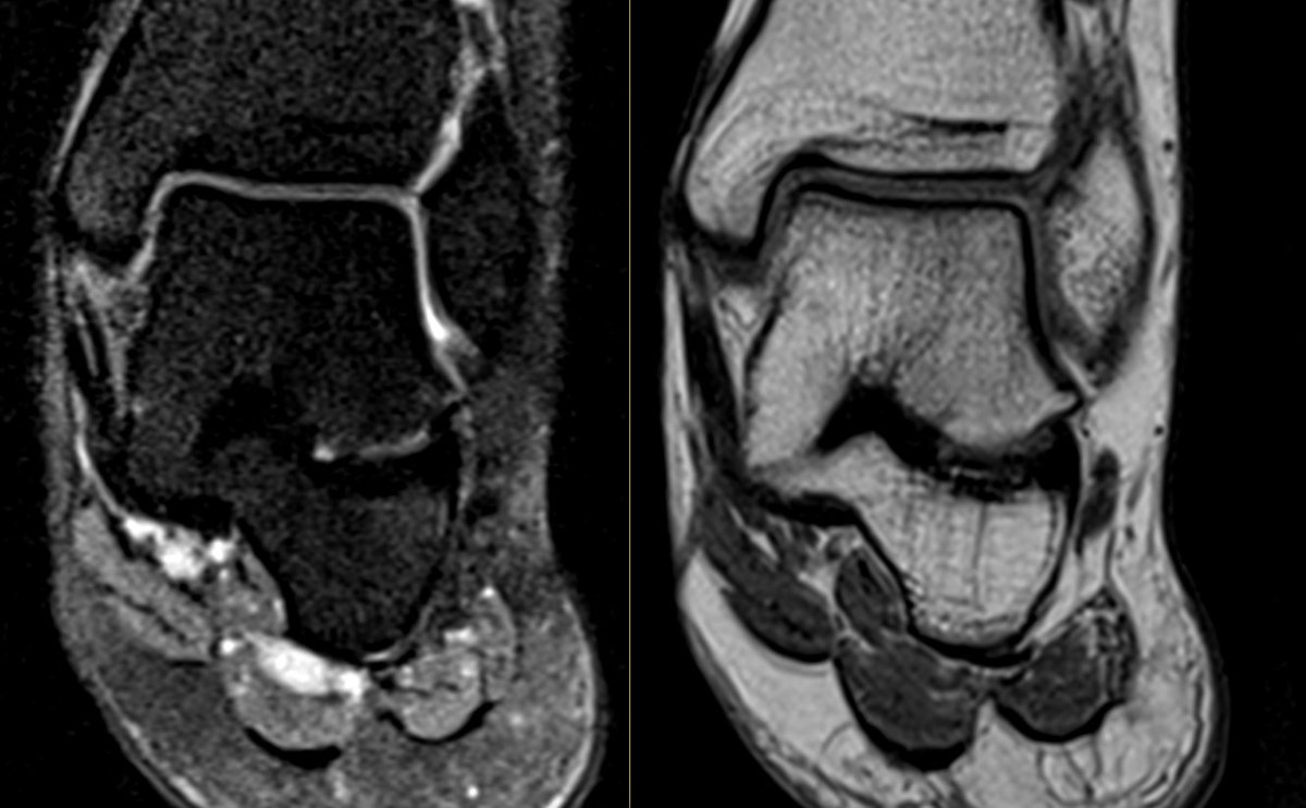 milli_Sievert's tweet photo. Talocalcaneal coalition type 4 (osseus) due to the lack of fibrous component as seen in the picture. Middle facet type being the most common and usually associated with pes planus (both depicted in this case). Also keep in mind the sinus tarsi, effaced with low fibrous signal 🧐 https://t.co/sIiGXMjBp2