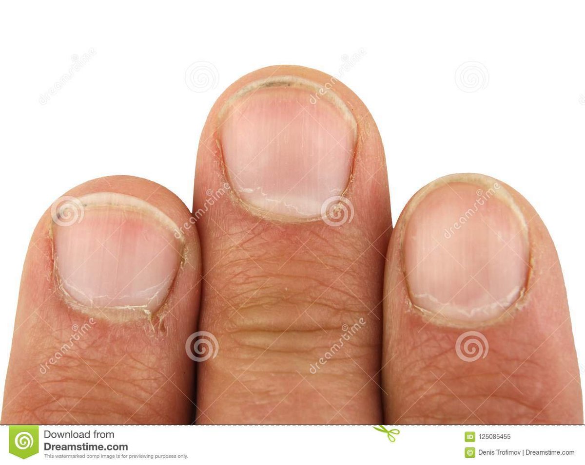 Nervotic ️ on Twitter "People cutting off their fingers and toes because they realise they have