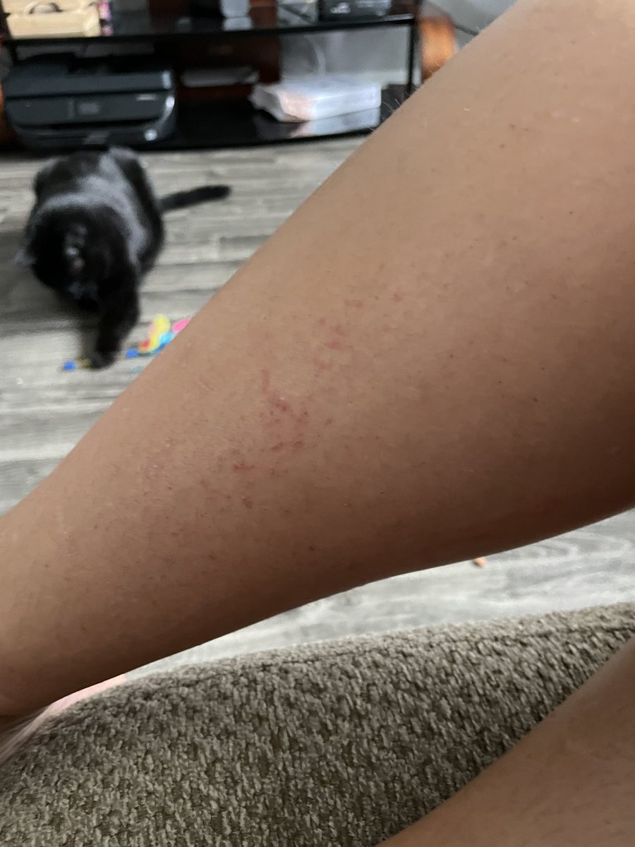 Almost two weeks later &amp; I still have a mark from my Jellyfish sting. 😬