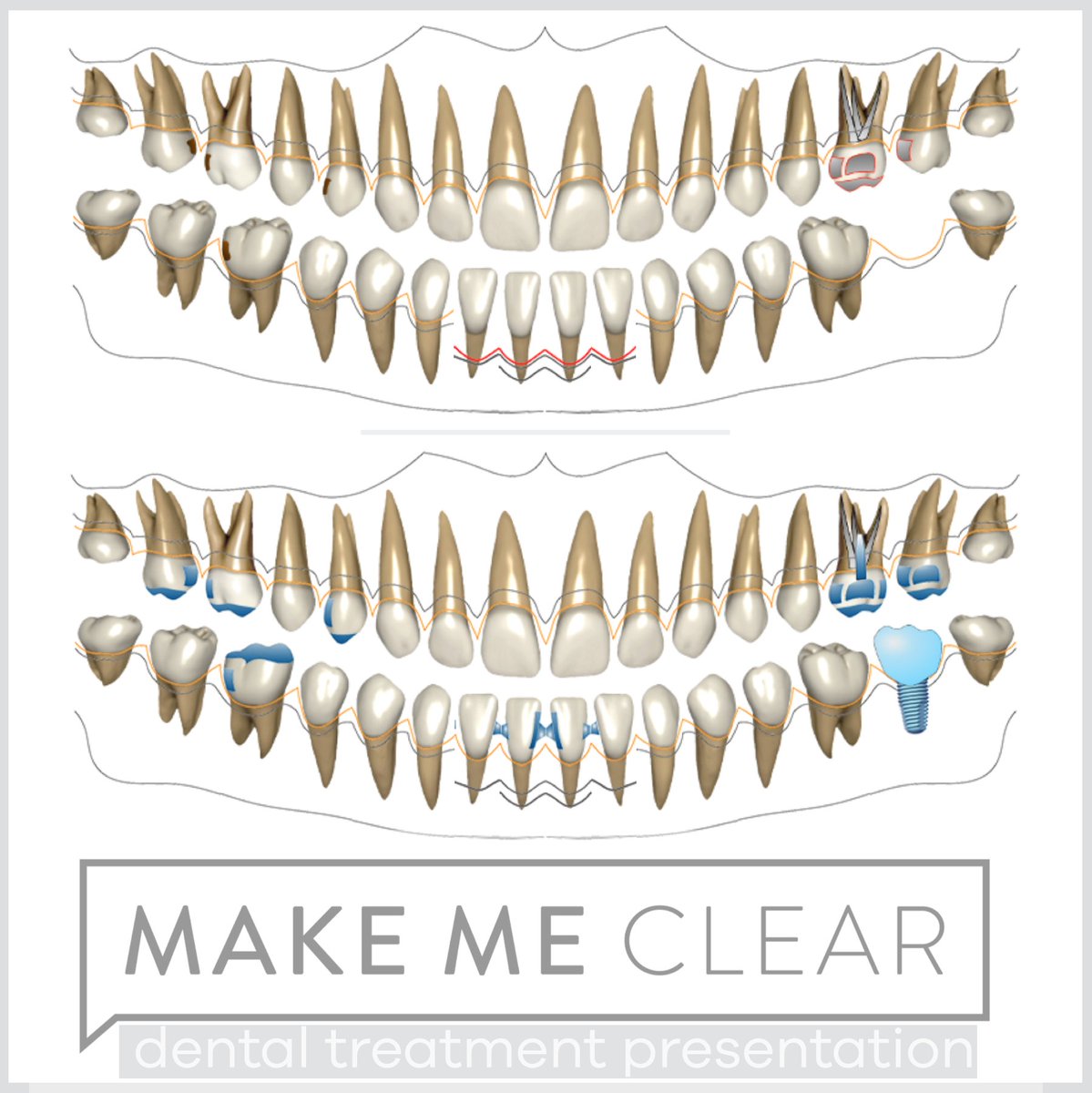 makemeclearapp's tweet photo. https://t.co/GTFH40K8LC

•
•
•
•
•

#treatmentplanning #dentistry #dentalsoftware #treatmentplanpresentation #planpresentation #communicationindentistry #interdisciplinarydentistry
#dentalmarketing https://t.co/rfFgK0ZChQ