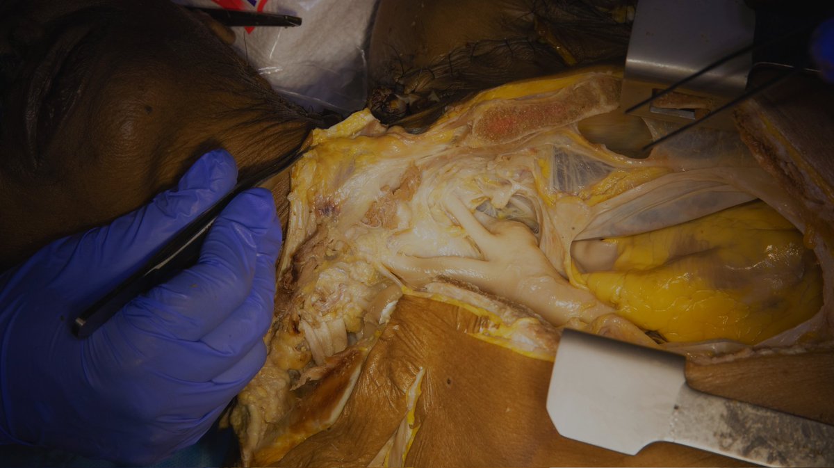 VascAnatCourse's tweet photo. Sternotomy with cervical extension. Thymectomy. Innominate vein ligated and cut. Pericardiotomy.
Exposure of proximal ascending aorta and the arch vessels.
#thewaytomyheart
@VascAnatCourse @pcvasc @GnaneswarAtturu @PShivanesandr @SavlaniaAjay @PrajnaKota @DrFayaz18 https://t.co/mEjDd2SWLI