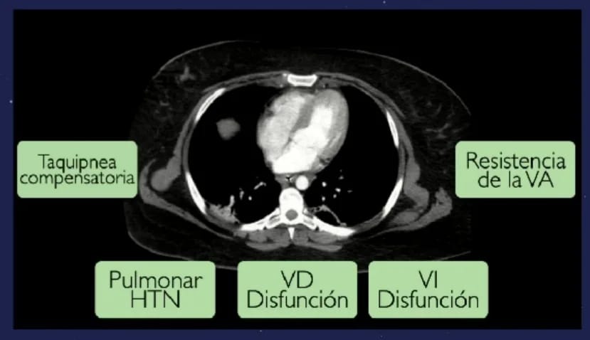 ConceptosUC's tweet photo. Obeso critico en emergencias, con Dr. Alejandro Moya @alemoyaal
👉Desafíos: Vía aérea, Mecánica pulmonar, Cardiovascular, Gastrointestinal y Monitoreo hemodinámico👈
- Limitaciones en Vía aerea dificil 
- IOT: en rampa o 45°
- Ventilación: PROTECTORA
- Drogas: IBW
# Conceptosuc22 https://t.co/N97FFFYCvV