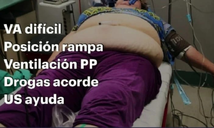 ConceptosUC's tweet photo. Obeso critico en emergencias, con Dr. Alejandro Moya @alemoyaal
👉Desafíos: Vía aérea, Mecánica pulmonar, Cardiovascular, Gastrointestinal y Monitoreo hemodinámico👈
- Limitaciones en Vía aerea dificil 
- IOT: en rampa o 45°
- Ventilación: PROTECTORA
- Drogas: IBW
# Conceptosuc22 https://t.co/N97FFFYCvV