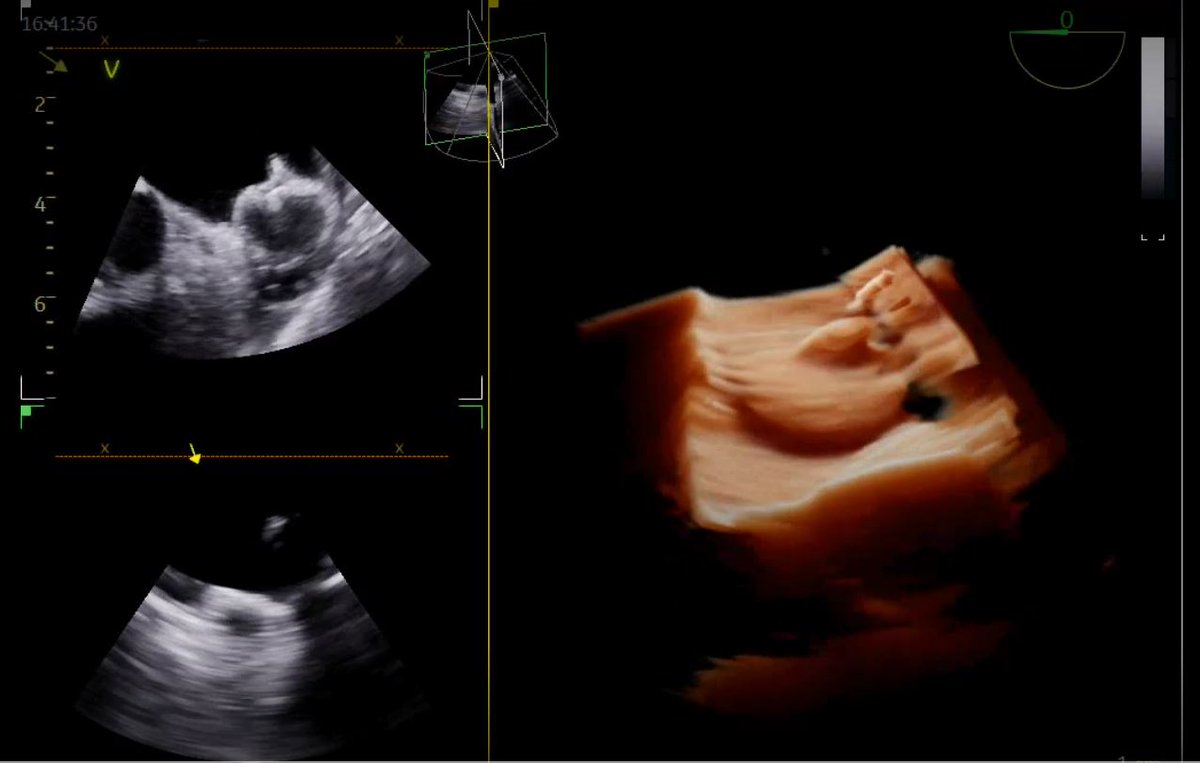 GaHeart_NGHS's tweet photo. On Tuesday, Georgia Heart Institute in Gainesville became the first hospital in the state of Georgia to perform an LAA closure procedure using the @BiosenseWebster NuVision 4D ICE catheter! Days like these help us achieve optimal outcomes for our patients #CardioTwitter #NUVISION https://t.co/J1bH3mbNeK