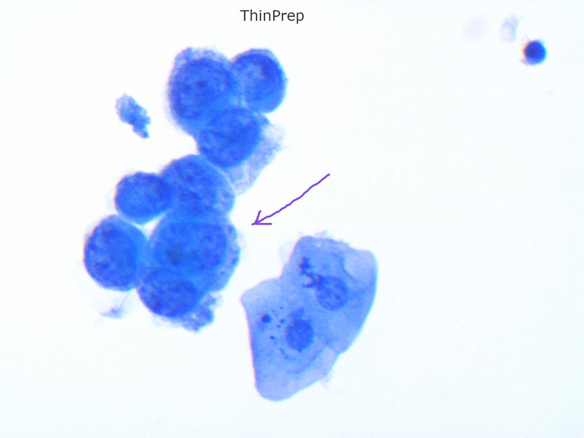 Miryousufkhan3's tweet photo. Size matters, especially in cytology. This high-grade urothelial carcinoma in voided urine has an N/C ratio of >0.7 #parissystem got this one very precise. #cytopathology #pathology https://t.co/2gVkKUS5se