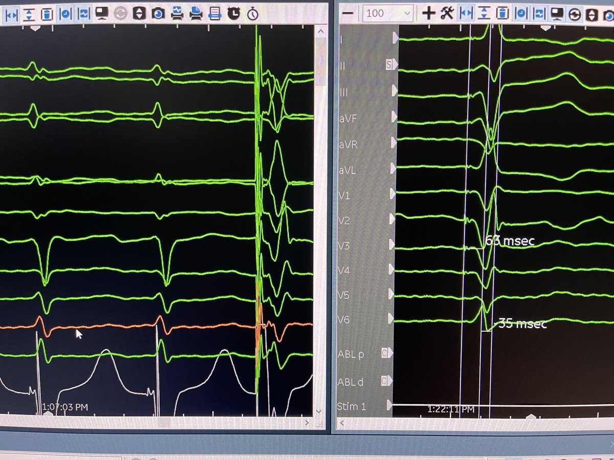 Av node ablations have never been this much fun. Lbb potential on lbb lead, very pretty paced qrs post ablation. Selectra sheath is just awesome. #biotronik ⁦<a href="/BIOTRONIK_US/">BIOTRONIK US</a>⁩