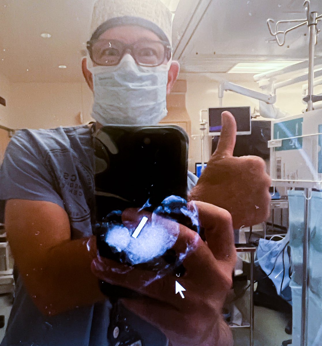 Targeted axillary node dissection BOOM! #magseed <a href="/MagseedSurgery/">Magseed®</a> <a href="/endomag/">Endomag, A Hologic Company</a>
