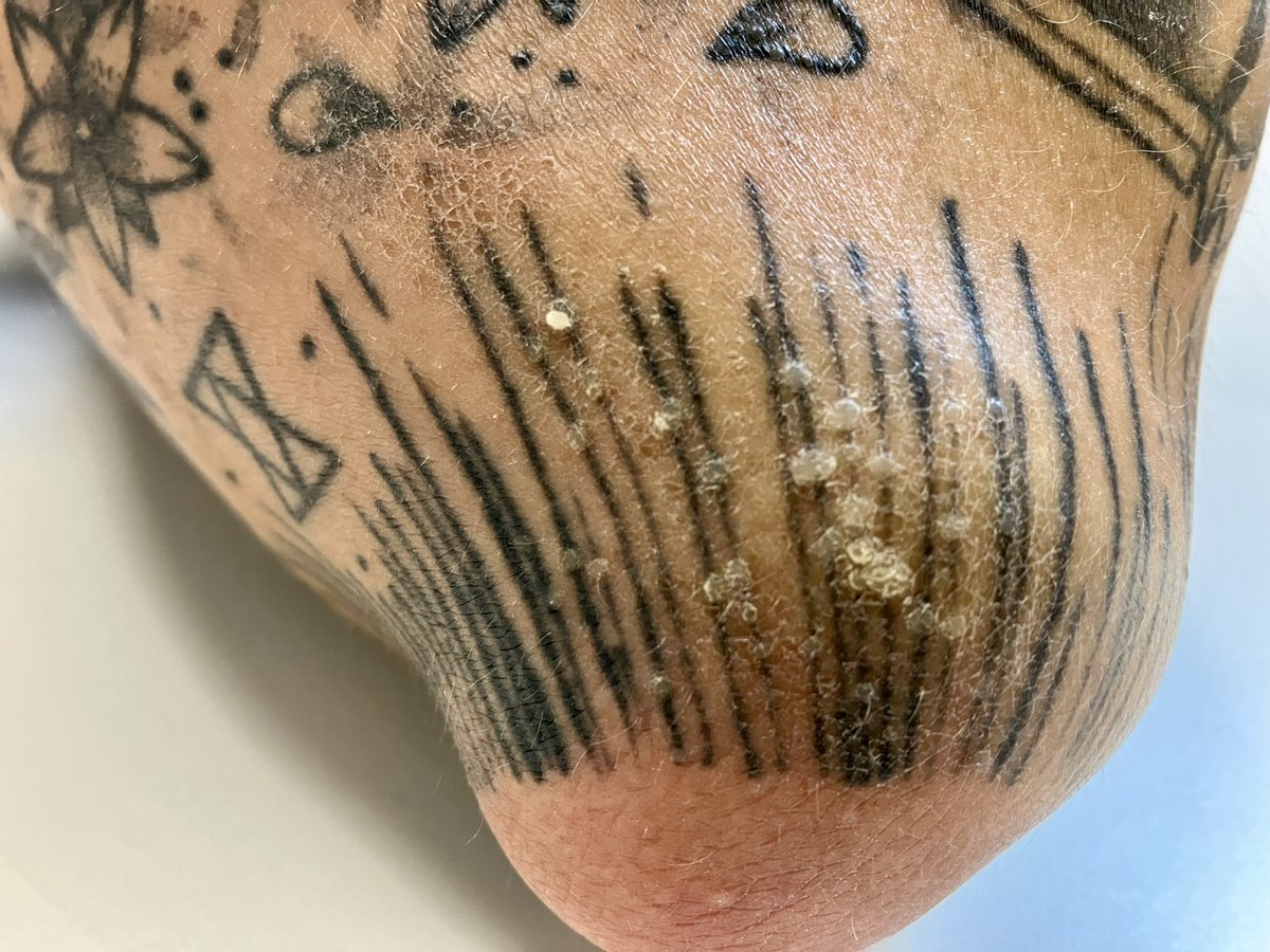 allobe86's tweet photo. Tatuaje y verrugas múltiples

Una pista para pensar en contaminación de la tinta o del equipo para realizar el tatuaje con virus del papiloma humano,es que cada verruga está centrada por un rayo de tinta

Mala praxis del tatuador 😵‍💫
#dermtwitter #dermatology #dermatologia #2MIR23 https://t.co/3G4GBlEo9t