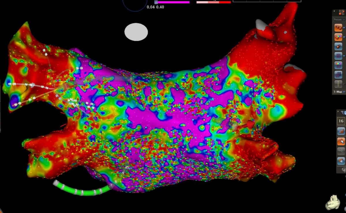 Michail Efremidis (@mefraimidis) on Twitter photo First two cases ( AF ) using Octaray. Gratitude to Kosmas Valkanas and Paraskevi Skoufogiani for making this possible. <a href="/vlachoskonstan1/">Konstantinos Vlachos</a> <a href="/SteliosDragasis/">Stelios</a> <a href="/K_Letsas/">Konstantinos Letsas</a> <a href="/CosmoValkanas/">Kosmas Valkanas</a> <a href="/PSkoufogianni/">Paraskevi Skoufogianni</a> #onassiscardiacsurgerycenter First two cases ( AF ) using Octaray. Gratitude to Kosmas Valkanas and Paraskevi Skoufogiani for making this possible. <a href="/vlachoskonstan1/">Konstantinos Vlachos</a> <a href="/SteliosDragasis/">Stelios</a> <a href="/K_Letsas/">Konstantinos Letsas</a> <a href="/CosmoValkanas/">Kosmas Valkanas</a> <a href="/PSkoufogianni/">Paraskevi Skoufogianni</a> #onassiscardiacsurgerycenter 