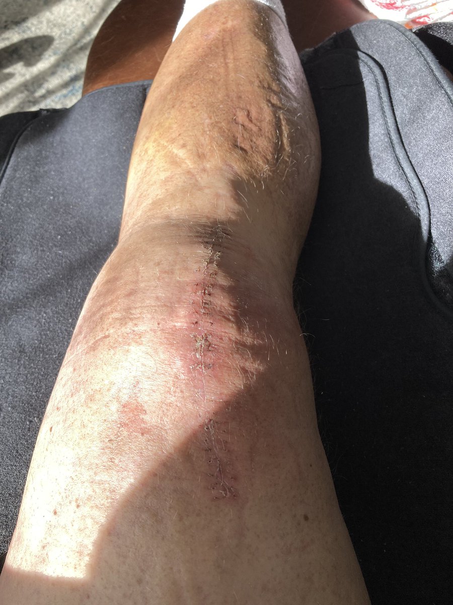 Welp we’re into the third week of straight leg syndrome and doc said today it’ll be another four weeks till i can start to bend it. Worst problem is is having a crap with a straight leg. It’s like peeing with an erection you never know where it’s going to land!!!!!