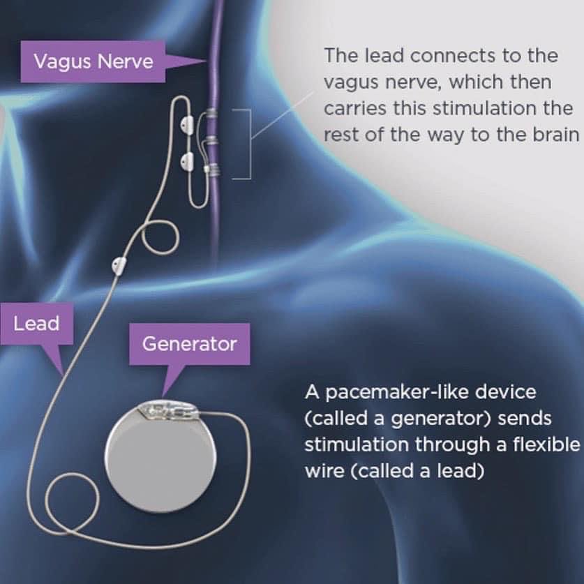 Celebrating the 1yr anniversary of my VNS implant for treatment-resistant depression 🪫🔋 Surgery was one of the best decisions I’ve ever made for myself #VagusNerveStimulator