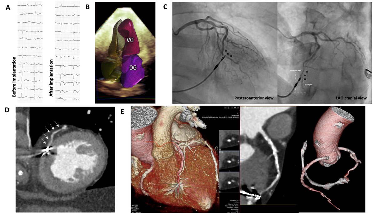 Simon Fitouchi (@simon_fitouchi) on Twitter photo #EHJCaseReports Cardiovascular Flashlight: Atypical left anterior descending coronary artery damage after pacemaker lead insertion
doi.org/10.1093/eurhea…
<a href="/ESC_Journals/">European Society of Cardiology Journals</a> <a href="/escardio/">European Society of Cardiology</a> <a href="/ehj_ed/">EHJ Editor-in-Chief</a>
#EHJCaseReports #EHJ #Cardiology #CardioTwitter #EHJCaseReports Cardiovascular Flashlight: Atypical left anterior descending coronary artery damage after pacemaker lead insertion
doi.org/10.1093/eurhea…
<a href="/ESC_Journals/">European Society of Cardiology Journals</a> <a href="/escardio/">European Society of Cardiology</a> <a href="/ehj_ed/">EHJ Editor-in-Chief</a>
#EHJCaseReports #EHJ #Cardiology #CardioTwitter