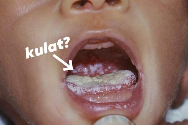 dr_chaku's tweet photo. "Doktor, lidah anak saya ni ada tompok² putih. Saya cuba letak air kencing, tapi tak hilang!"

Ada orang panggil ni "kulat susu". Benar, ia adalah sejenis jangkitan kulat, candida albicans namanya. Namun, ia bukan disebabkan oleh susu. Susu tu merujuk kepada warna dan rupa dia. https://t.co/5GtcnJ4Zqs