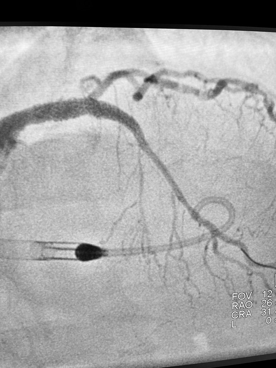 Excited to report first #CHIP #Impella assisted PCI in a high risk case with last remaining conduit <a href="/harrishealth/">Harris Health</a> <a href="/BCMDeptMedicine/">BCM Department of Medicine</a> <a href="/BCMHeart/">BCM Cardiology</a> <a href="/TXMedCenter/">Texas Medical Center</a> amazing team work <a href="/WKayaniMD/">Waleed Kayani</a> <a href="/jia_xiaoming/">Xiaoming Jia</a> <a href="/john_suffredini/">John M Suffredini</a>  <a href="/JRH_MD/">Josh Hirsch, MD</a> and all #cathlab #staff <a href="/CBallantyneMD/">Christie Ballantyne</a> <a href="/SeragHashem/">Hashem el- Serag</a>