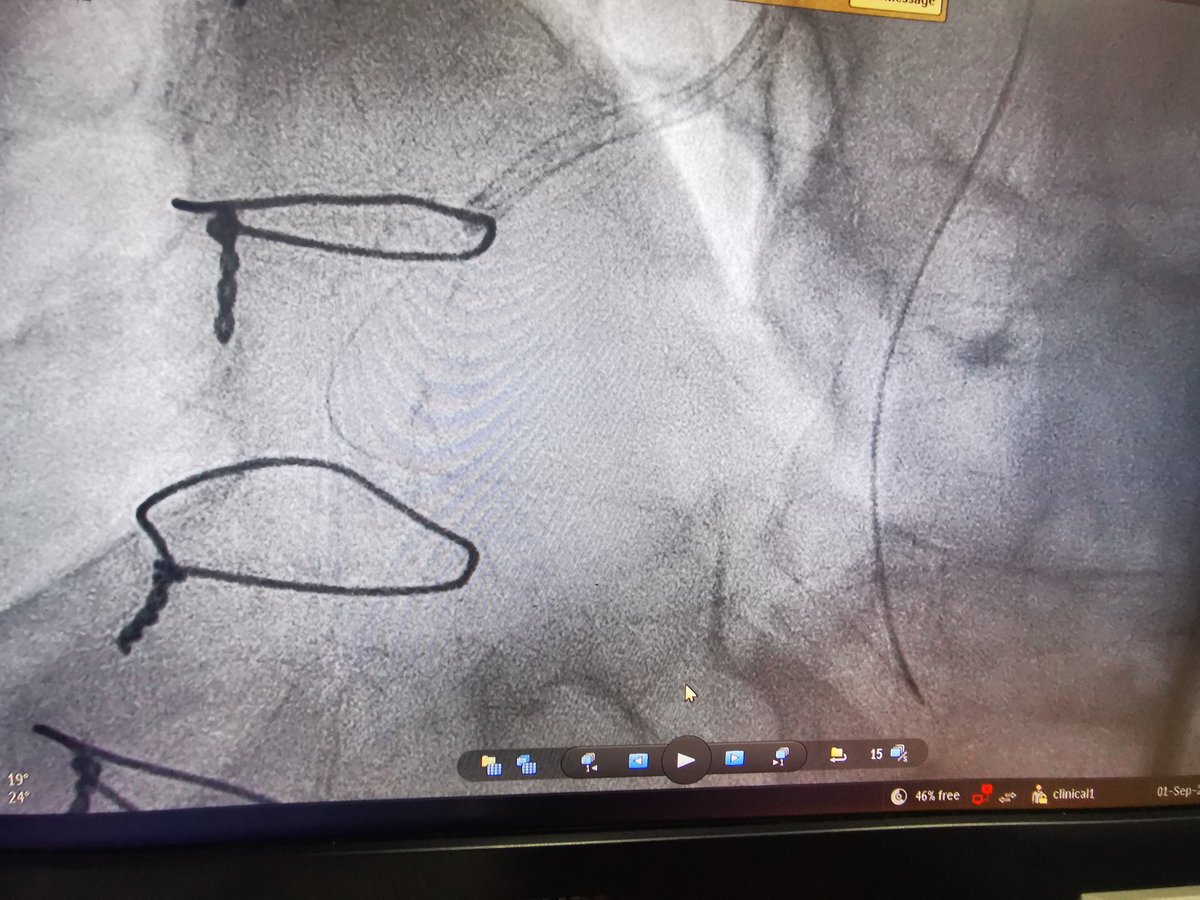 Honored to have used the first inflitrac wire retrograde #abbotvascular outside of the North American continent in a complex post cabg retrograde case #promedhospital #ctomd #ctopci
<a href="/aayshacader/">Aaysha Cader</a> <a href="/mirvatalasnag/">MIЯVΛƬ #IC ༄ ｡°</a> <a href="/Hragy/">Hany Ragy</a> <a href="/NishithChandra/">𝔻𝕣 ℕ𝕚𝕤𝕙𝕚𝕥𝕙 ℂ𝕙𝕒𝕟𝕕𝕣𝕒</a> <a href="/AtulMathur_/">Atul Mathur</a> <a href="/CTO_LIVEAID/">CTO LIVE AID</a>