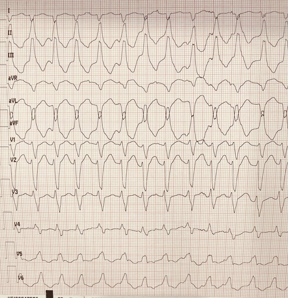Anna Sarcon, M.D, FACC, FHRS✨🐎✨ (@splithis) on Twitter photo 👇🏻NICM, EF 20%. where is this VT? 🤔 <a href="/Hapa_EP/">Kevin Brady</a> <a href="/HISrefrPVC/">EDiamantakos, DO, FACC, FHRS, FACOI</a> <a href="/EPShadi/">Shadi Kalantarian, MD, MPH</a> <a href="/DrEJKim/">EJ Kim</a> <a href="/DRosenth_/">Dave Rosenthal</a> <a href="/MRazminia/">Mansour Razminia</a> <a href="/aalahmadmd/">Amin Al-Ahmad, MD</a> <a href="/EPeeps_Bot/">EP_Bot</a> #Epeeps 👇🏻NICM, EF 20%. where is this VT? 🤔 <a href="/Hapa_EP/">Kevin Brady</a> <a href="/HISrefrPVC/">EDiamantakos, DO, FACC, FHRS, FACOI</a> <a href="/EPShadi/">Shadi Kalantarian, MD, MPH</a> <a href="/DrEJKim/">EJ Kim</a> <a href="/DRosenth_/">Dave Rosenthal</a> <a href="/MRazminia/">Mansour Razminia</a> <a href="/aalahmadmd/">Amin Al-Ahmad, MD</a> <a href="/EPeeps_Bot/">EP_Bot</a> #Epeeps
