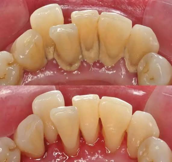 Heiihoooo 
mau nawarin nih ada yang mau scalling gigi (pembersihan gigi) *gratis* gaa ?? 🤭
DM yuk yg mau 
khusus daerah bandung 🫶🏻