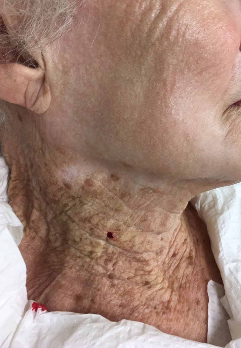 Mejillas y cuello de una mujer de 92 años, que utilizó cremas hidratantes con protección UV en la cara pero no en el cuello durante más de 40 años.
