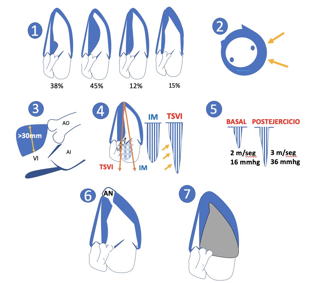 #MáximasEcocardiograficas (10)
1-Tipifica la hipertrofia con eco (90%)
2-Cuidado cara  lateral, si duda CRMN
3-Septo &gt;30 mm ,mal caso
4-No confundir gradiente-flujo mitral.
5-Haz siempre ejercicio aun sin disnea
6-Aneurisma apical,se te puede escapar
7-Si dudas en apex :Contraste