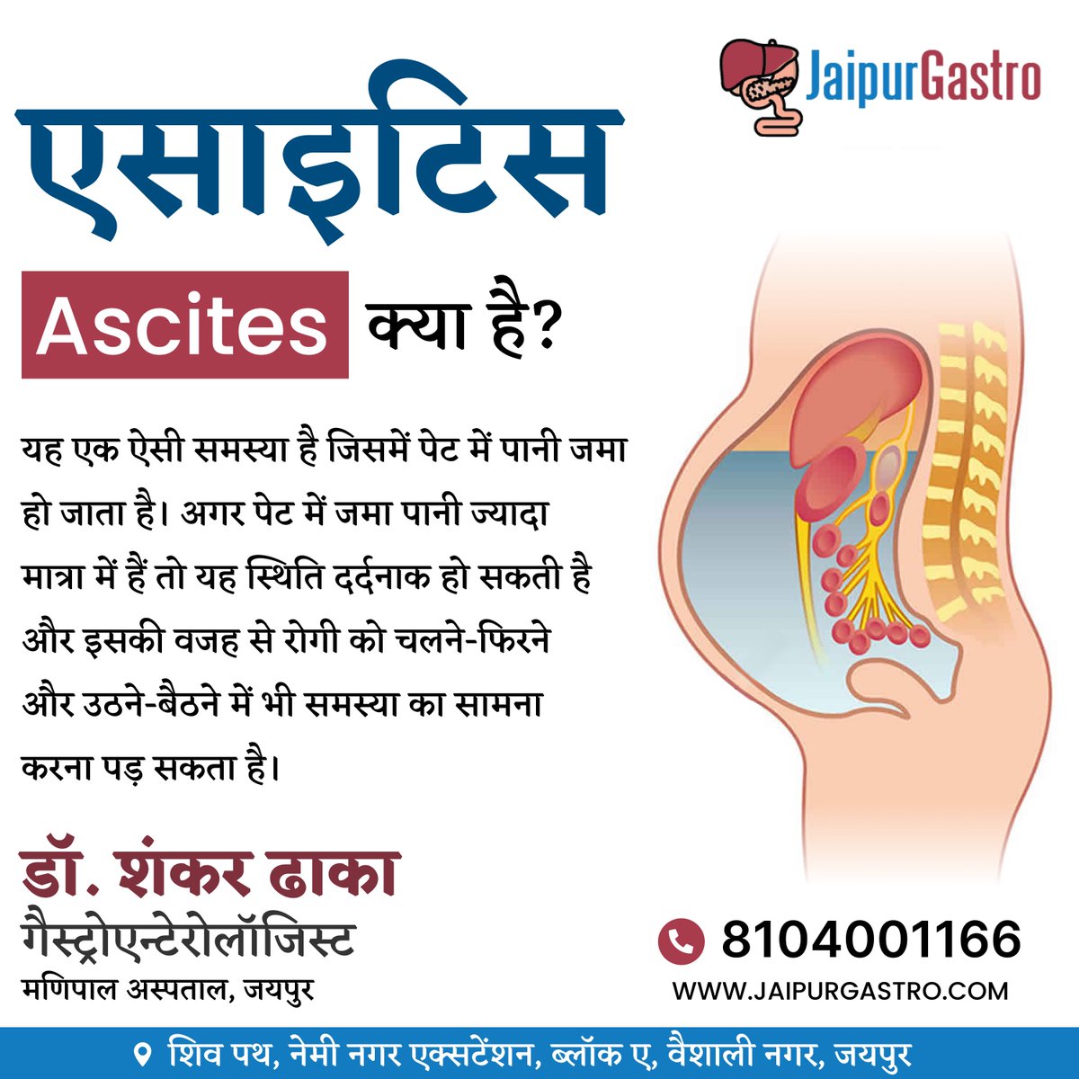 JaipurGastro's tweet photo. #एसाइटिस (#Ascites) क्या है?

#Gastroenterologist #Hepatologist #Endoscopist #Jaipur #JaipurGastro #gas #Acidity #ulcer #abdominalpain #Pancreatitis  #Gastroenteritis #GI #GICancer #Endoscopy #health #healthcare #stomachinfection #Stomachflu #doctor #manipalhospital #rajasthan https://t.co/dZj7NzQJEp