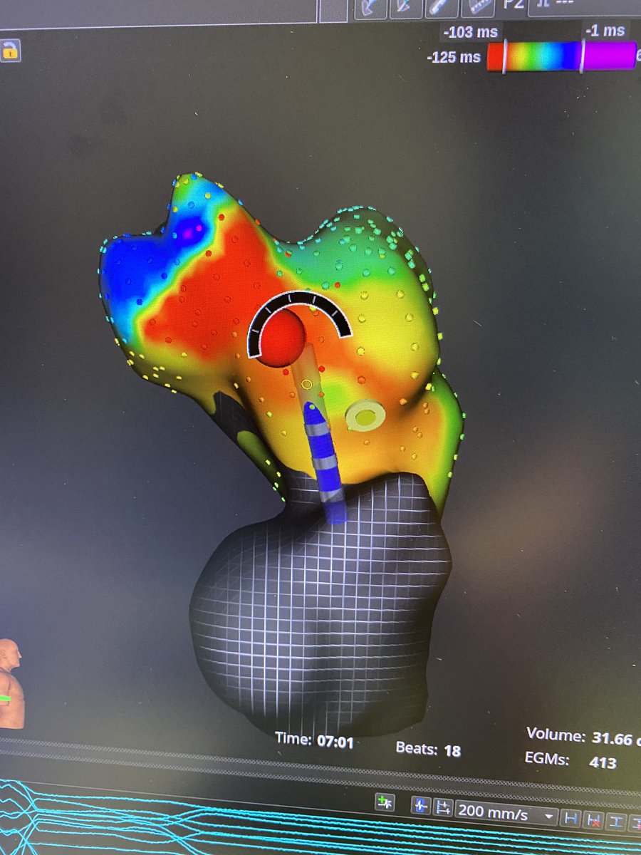 Another awesome day in the EP lab,  putting the #PowerOfFocal #PulsedElectricField ablation into the hands of <a href="/kottmaier_md/">Marc Kottmaier</a> and <a href="/BourierFelix/">Felix Bourier</a>. Integrating <a href="/medical_galaxy/">Galaxy Medical</a>’s #CENTAURI with #RHYTHMIAHDx and #STABLEPOINT was seamless. #epeeps