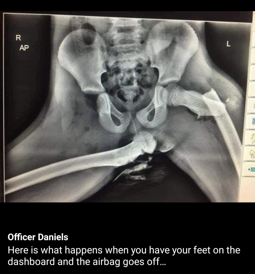 Looking for one good reason to never ride in the passenger seat with your legs up on the dashboard? Here it is.