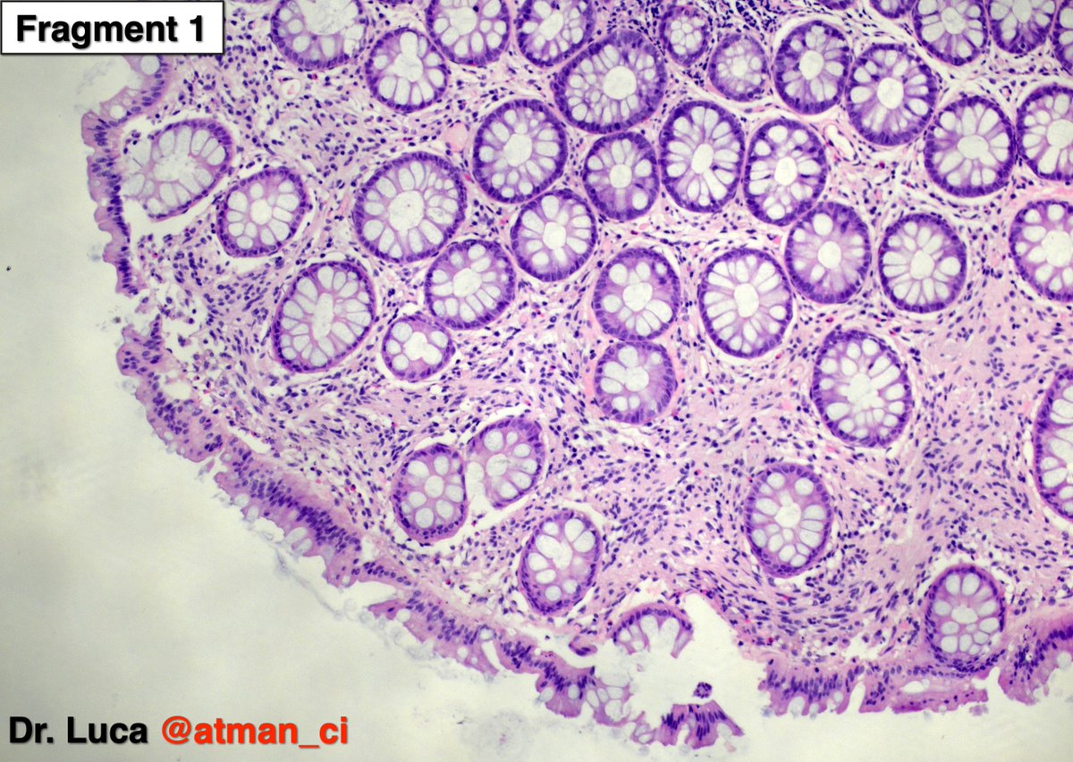 atman_ci's tweet photo. This week two #GIPath colon biopsies with 3 surprises! Biopsy N°1 sigma: what hides the 1° fragment and what the 2°? IHCs? @PoloniaAntonio @DrBMcGinn @goziemnweke @NeoCrazee @SumantaDas_7 @sumeyra_md @LoboAnandi @Teclis82 @GIJamesMD @DrMarkOng @vij_mukul @pembeoltulu #PathTwitter https://t.co/cG0pWQqWfl