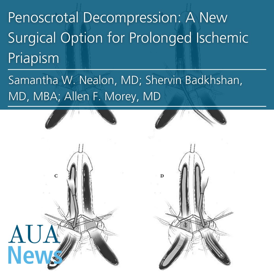 AmerUrological's tweet photo. "Penoscrotal Decompression: A New Surgical Option for Prolonged Ischemic Priapism"

#AUANews🔗

By: Samantha W. Nealon, MD; Shervin Badkhshan, MD, MBA; Allen F. Morey, MD #urology #MensHealth https://t.co/OGmcc21Vvl