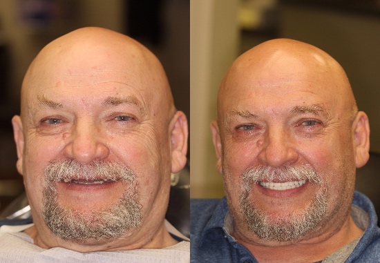 Lee got his Teeth in 24. ✔
He went without teeth for 30 years, and he finally decided to do something about it. His new implants have changed his life. 😃 

📱  Call 503-683-8787
💻  DrLampee.com 

#DrLampee #DrLampeeImplants #Veneers #Dentistry #SmileWithConfidence