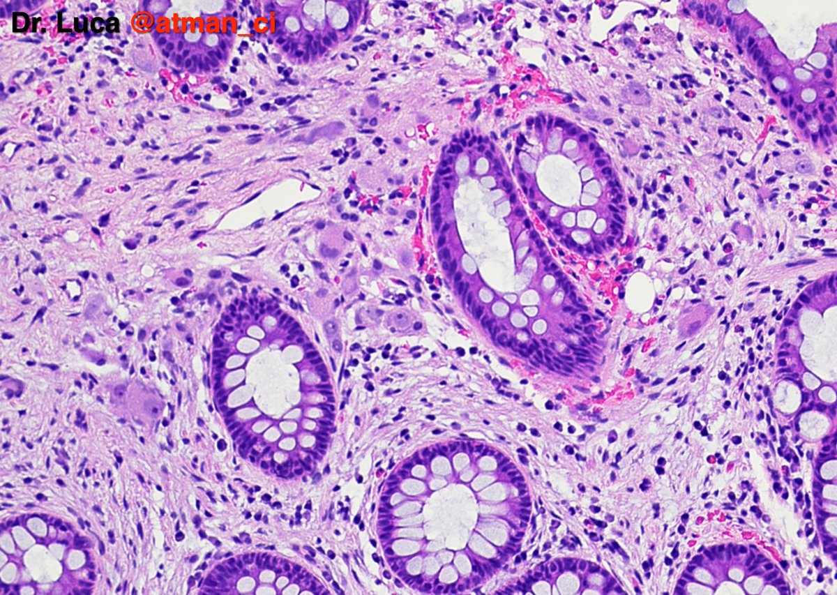 atman_ci's tweet photo. Biopsy N°2, rectum: here we have only one surprise, what is it about? IHCs? @PoloniaAntonio @DrBMcGinn @goziemnweke @NeoCrazee @sumeyra_md @LoboAnandi @Teclis82 @GIJamesMD @DrMarkOng @vij_mukul @pembeoltulu @Venkateshgilly2 @DrGeeONE @SumantaDas_7 #pathology #PathTwitter #GIPath https://t.co/gZVjGkAZs8