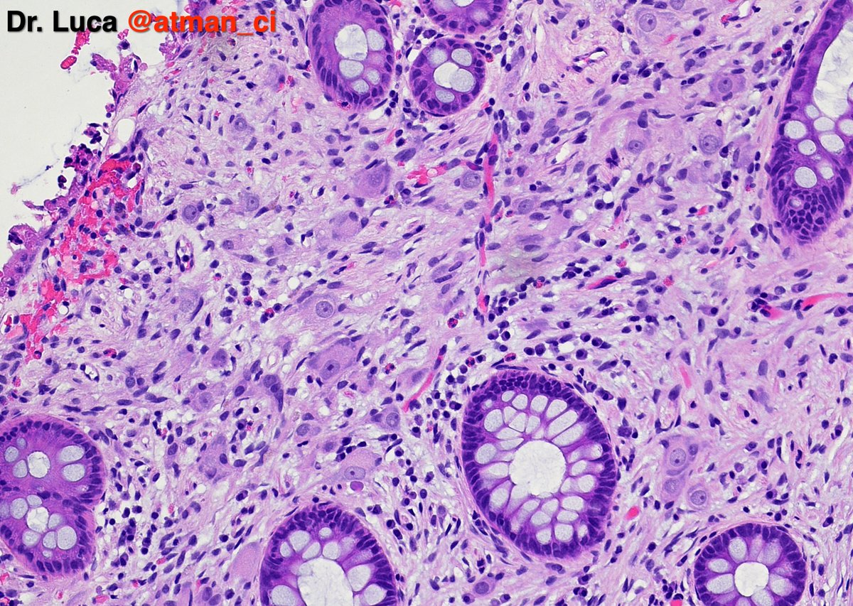 atman_ci's tweet photo. Biopsy N°2, rectum: here we have only one surprise, what is it about? IHCs? @PoloniaAntonio @DrBMcGinn @goziemnweke @NeoCrazee @sumeyra_md @LoboAnandi @Teclis82 @GIJamesMD @DrMarkOng @vij_mukul @pembeoltulu @Venkateshgilly2 @DrGeeONE @SumantaDas_7 #pathology #PathTwitter #GIPath https://t.co/gZVjGkAZs8