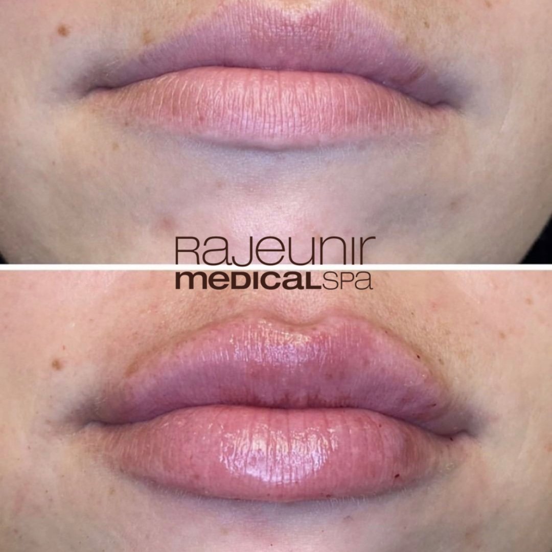😍Another set of new lips, fresh off the needle! (bruising and swelling present)
💋 Treatment: HA Lip Filler 
💖 Purpose: Plump and hydrate lips
⭐ Longevity: 9-12 months (on average)
💉 Expect bruising and swelling, fully healed around 2 weeks 

#rmedspa #rajeunir #medispa #lips