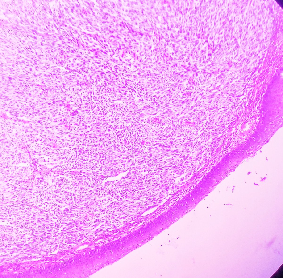 Prachi (@prachipath123) on Twitter photo Ulcerated Anal Amelanotic Melanoma in 60y/M. #APCON2022 #APCON2022PathTweet <a href="/GIJamesMD/">GI James</a> <a href="/padmapathology1/">Padma Priya J</a> <a href="/Kenny92954457/">Kenny De Gracia T.</a> <a href="/archibhat3/">Archana bhat</a> <a href="/adi_agnihotri/">Aditya Agnihotri 🇮🇳</a> <a href="/VijayPatho/">Vijay Shankar S</a> <a href="/AnnieAWu/">Annie A. Wu, MD, PhD</a> <a href="/DrGeeONE/">Olaleke Folaranmi</a> <a href="/Daisymdpath/">Daisy Maharjan</a> <a href="/Dob_Steino/">Dante</a> <a href="/dr_amenona/">Aswathy Menon Ananthvikas</a> <a href="/DrAnilaSharma1/">Dr Anila Sharma</a> <a href="/Chucktowndoc/">Frank Ingram, MD</a> <a href="/DrAruDeb/">Arunima Deb, MD</a> #pathology #PathTwitter Ulcerated Anal Amelanotic Melanoma in 60y/M. #APCON2022 #APCON2022PathTweet <a href="/GIJamesMD/">GI James</a> <a href="/padmapathology1/">Padma Priya J</a> <a href="/Kenny92954457/">Kenny De Gracia T.</a> <a href="/archibhat3/">Archana bhat</a> <a href="/adi_agnihotri/">Aditya Agnihotri 🇮🇳</a> <a href="/VijayPatho/">Vijay Shankar S</a> <a href="/AnnieAWu/">Annie A. Wu, MD, PhD</a> <a href="/DrGeeONE/">Olaleke Folaranmi</a> <a href="/Daisymdpath/">Daisy Maharjan</a> <a href="/Dob_Steino/">Dante</a> <a href="/dr_amenona/">Aswathy Menon Ananthvikas</a> <a href="/DrAnilaSharma1/">Dr Anila Sharma</a> <a href="/Chucktowndoc/">Frank Ingram, MD</a> <a href="/DrAruDeb/">Arunima Deb, MD</a> #pathology #PathTwitter