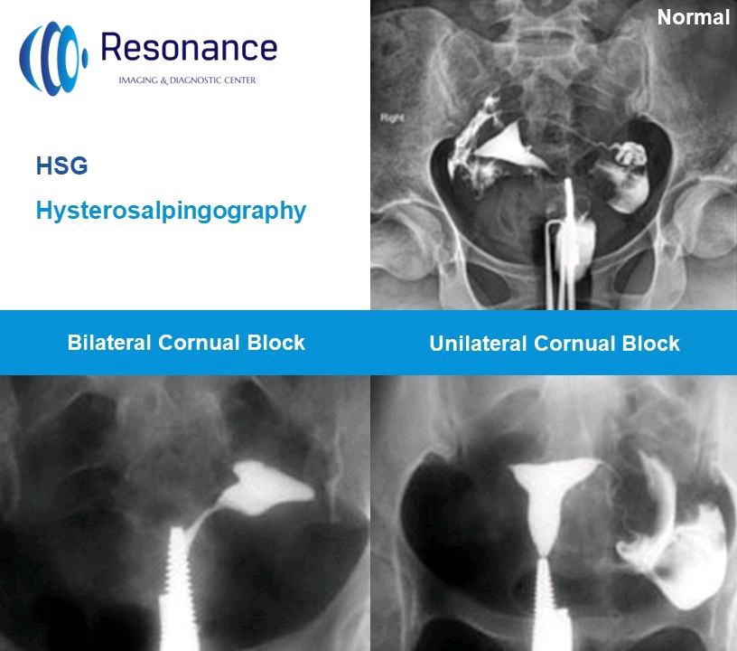 resonanceidc's tweet photo. #hysterosalpingogram (HSG) is a #fluoroscopic examination of the #uterus and the #fallopiantubes, most used in the #investigationofinfertility or #recurrentspontaneousabortions https://t.co/FIYvKCYPlu