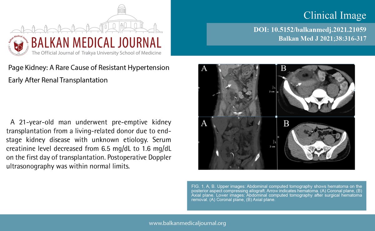 Page Kidney: A Rare Cause of Resistant Hypertension Early After Renal Transplantation

You can see the free full text of the research by Ahmet Burak Dirim et al.

Link : balkanmedicaljournal.org/uploads/pdf/pd…